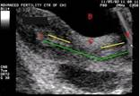 Перенос эмбрионов в полость матки 1