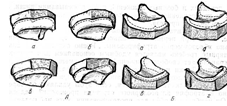  классификация беззубых челюстей 1