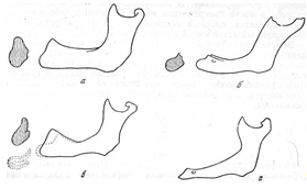  классификация беззубых челюстей 3